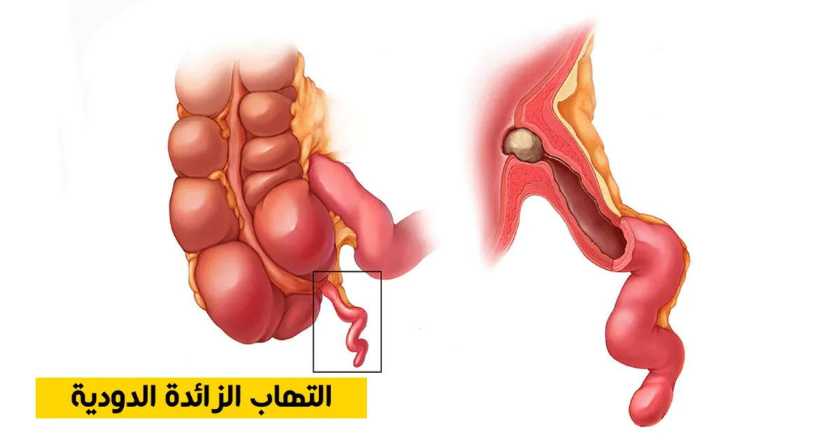 التهاب الزائدة الدودية